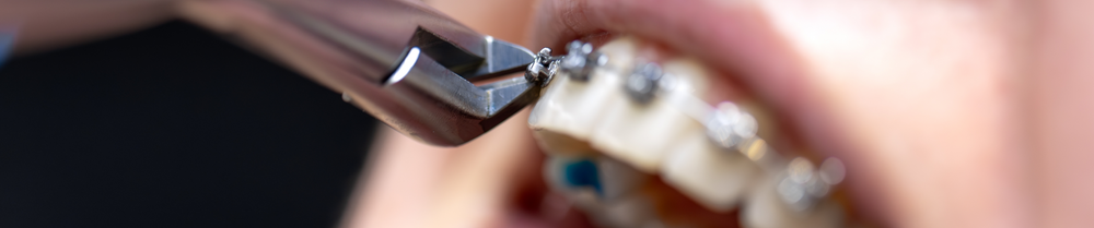 Braces and Aligners: How to Protect Enamel During Orthodontics