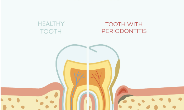 How to Prevent & Treat Periodontal Disease