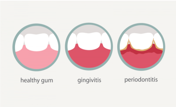 How to Treat Gum Disease and Gingivitis